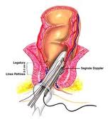  Emorroidi: terapia in day surgery, THD